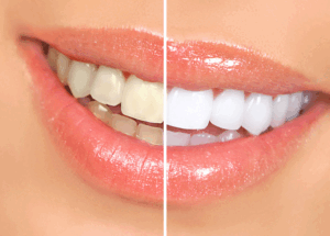 teeth whitening near noida sec 50