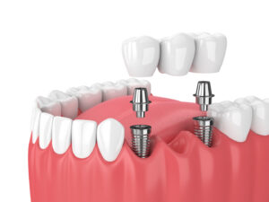 top dental implant specialist in Noida