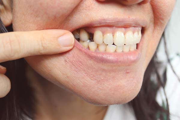 Missing Teeth Treatment By Dr Shalini Singh